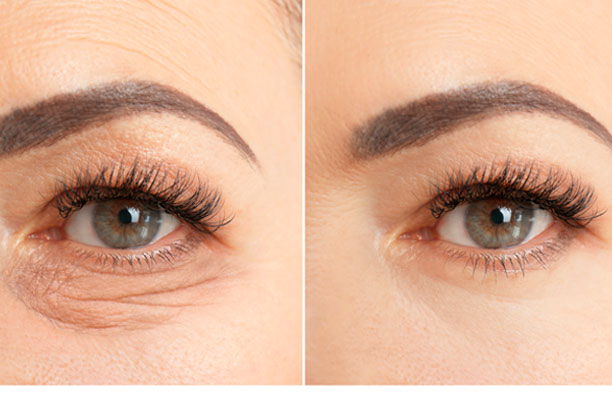 Blefaroplastia